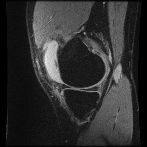 File:Anterior cruciate ligament tear (Radiopaedia 61500-69462 F 17).jpg