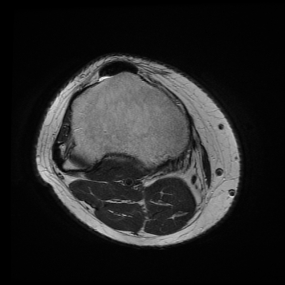 File:Anterior cruciate ligament tear with posteromedial corner injury, bucket-handle meniscal tear and chondral delamination (Radiopaedia 75501-86744 Axial T2 2).jpg