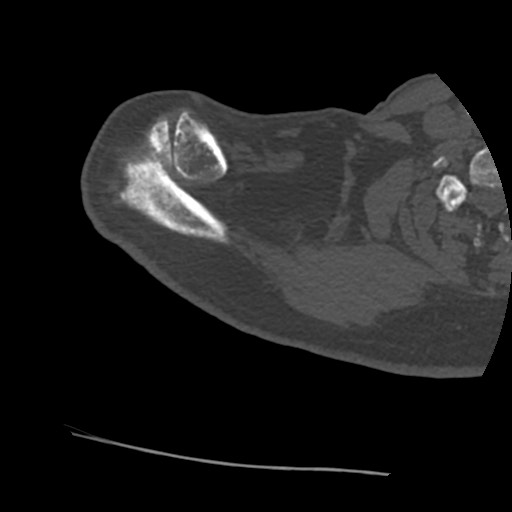 Anterior glenohumeral dislocation with Hill-Sachs lesion (Radiopaedia 62877-71249 Axial bone window 10).jpg