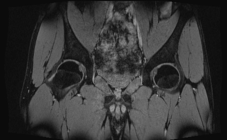 Anterior inferior iliac spine avulsion fracture (Radiopaedia 81312-95000 G 51).jpg