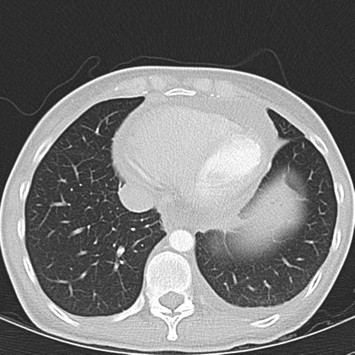 Anterior mediastinal lymphoma (Radiopaedia 29556-30061 Axial lung window 43).jpg