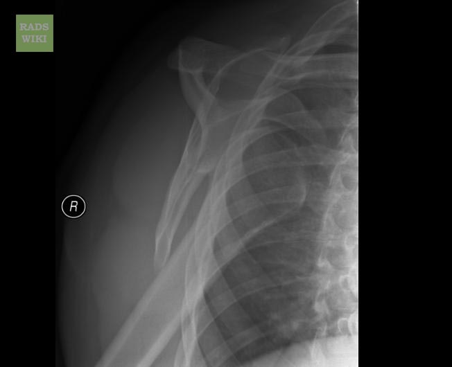 File:Anterior shoulder dislocation (Radiopaedia 11194-11558 Lateral 1).jpg