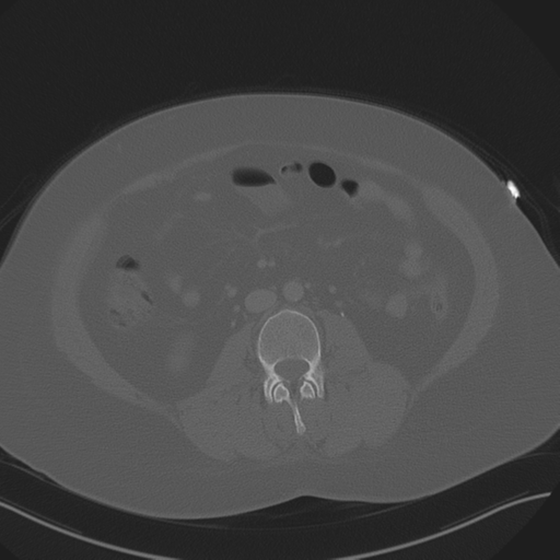 Anterior superior iliac spine avulsion fracture (Radiopaedia 44541-48244 Axial bone window 52).png