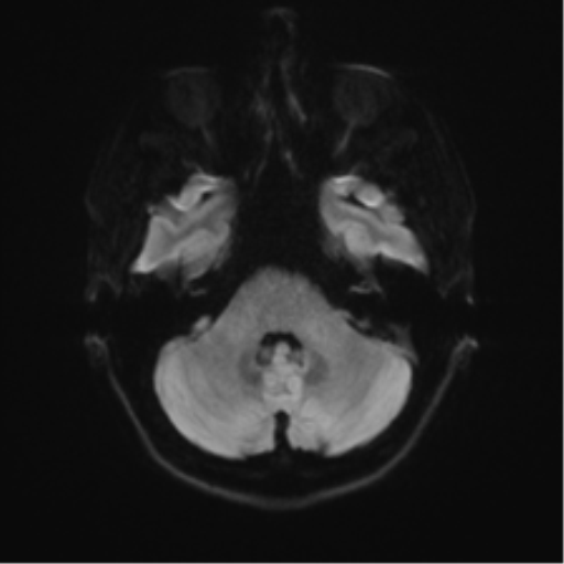 Anterior temporal lobe perivascular space (Radiopaedia 40946-43650 Axial DWI 33).png