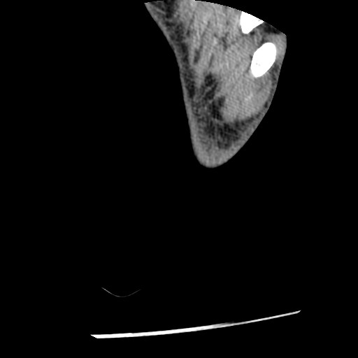 Anterior tibial artery false aneurysm (Radiopaedia 88984-105809 A 266).jpg