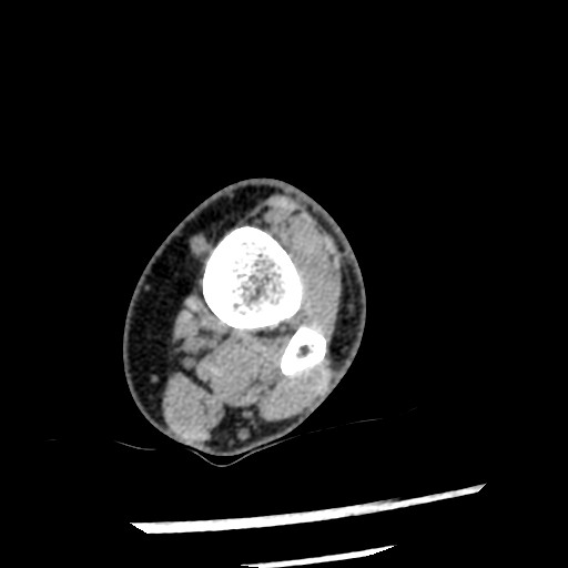 Anterior tibial artery false aneurysm (Radiopaedia 88984-105809 A 61).jpg