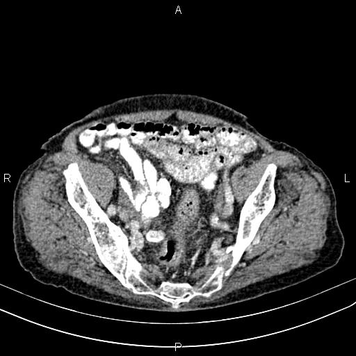 File:Aortic aneurysm and Lemmel syndrome (Radiopaedia 86499-102554 A 65).jpg
