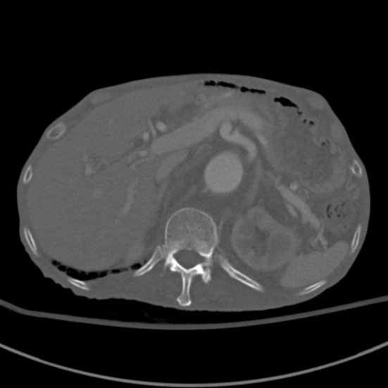 Aortic aneurysm with spinal destruction (Radiopaedia 42301-45410 Axial bone window 24).jpg
