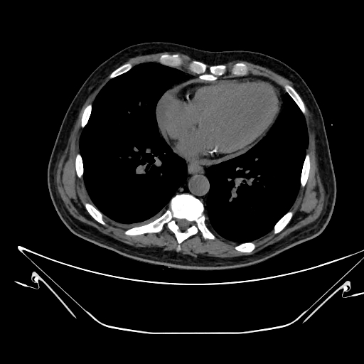 File:Aortic arch aneurysm (Radiopaedia 84109-99365 Axial non-contrast 184).jpg
