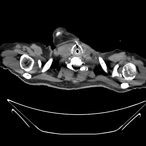Aortic arch aneurysm (Radiopaedia 84109-99365 Axial non-contrast 5).jpg