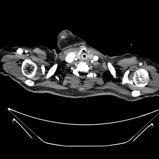 File:Aortic arch aneurysm (Radiopaedia 84109-99365 B 12).jpg