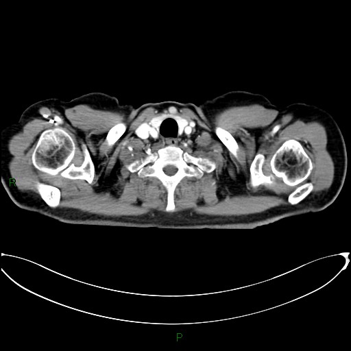 Aortic arch origin of left vertebral artery (Radiopaedia 46327-50737 Axial post contrast 5).jpg