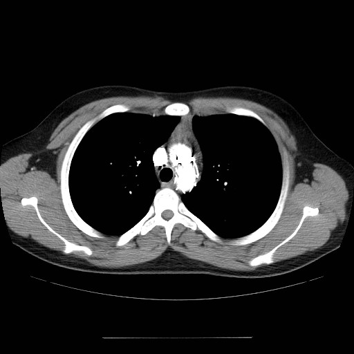 File:Aortic arch stent (Radiopaedia 30030-30595 D 10).jpg