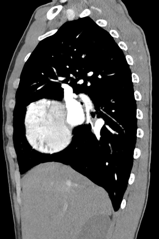 Aortic coarctation with aneurysm (Radiopaedia 74818-85828 B 54).jpg
