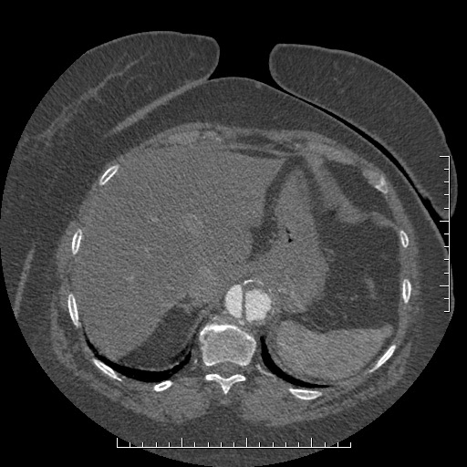 Aortic dissection- Stanford A (Radiopaedia 35729-37268 B 24).jpg