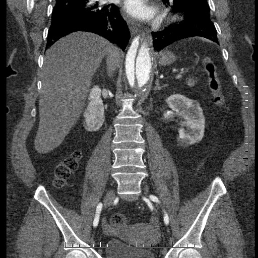 File:Aortic dissection- Stanford A (Radiopaedia 35729-37268 F 22).jpg
