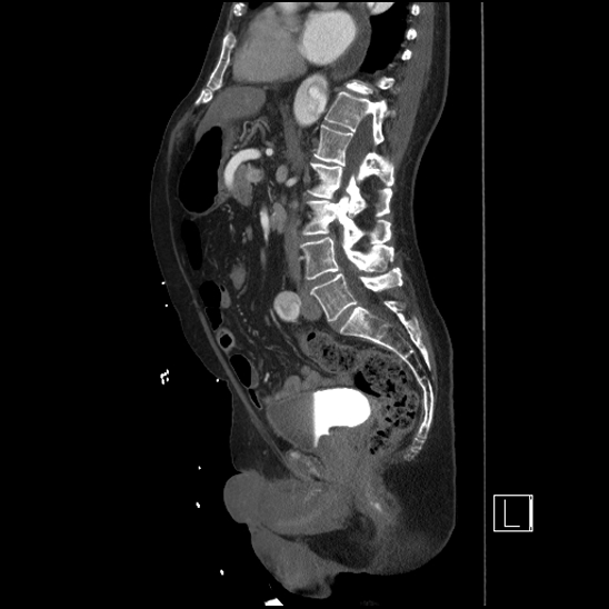 Aortic dissection (CTPA) (Radiopaedia 75506-86750 G 55).jpg