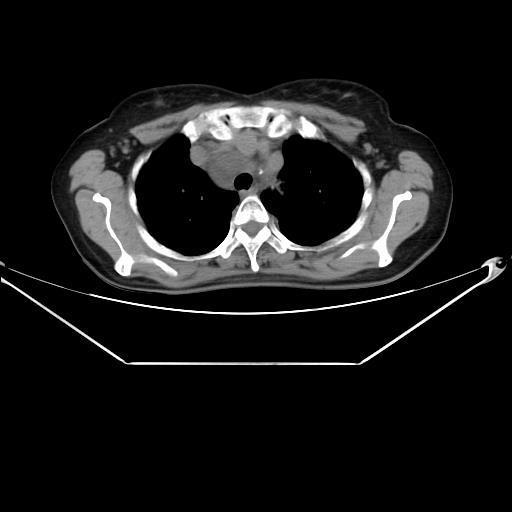 File:Aortic dissection (Radiopaedia 25350-25604 B 13).jpg