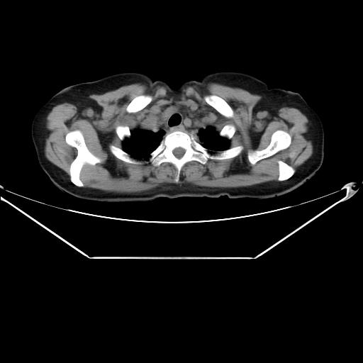 Aortic dissection (Radiopaedia 25350-25604 B 9).jpg
