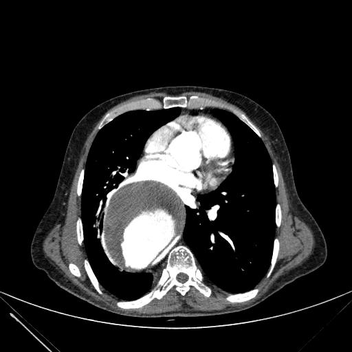 Aortic dissection (Radiopaedia 27466-27665 C+ arterial phase 150).jpg