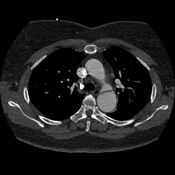 Aortic dissection (Radiopaedia 57969-64959 A 115).jpg