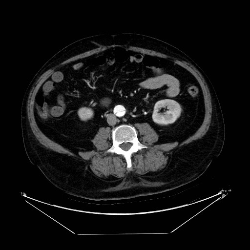 Aortic dissection (Radiopaedia 62562-71000 A 75).jpg