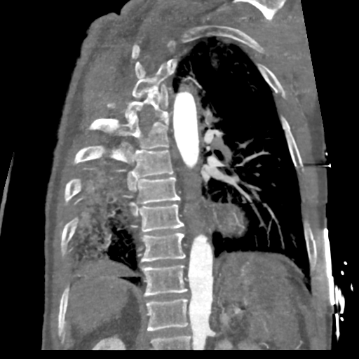 File:Aortic dissection - DeBakey type II (Radiopaedia 64302-73082 D 20).png