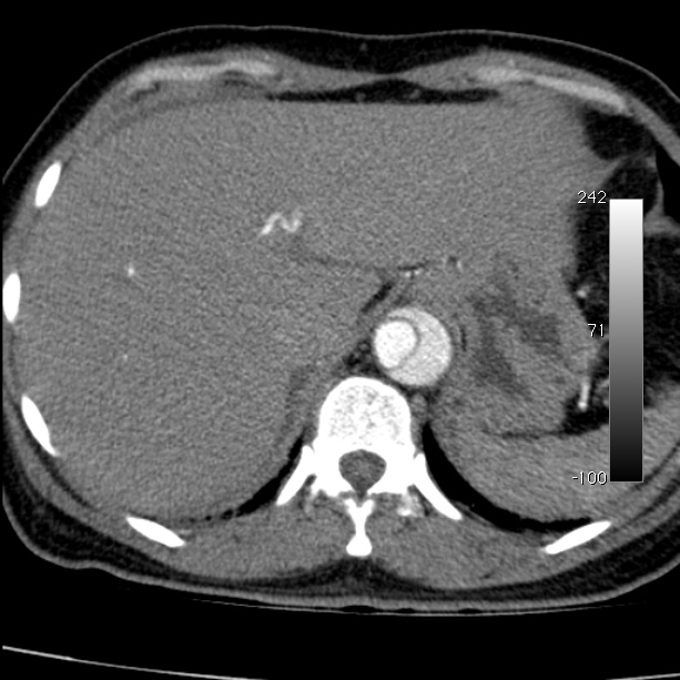 Aortic dissection - Stanford type A (Radiopaedia 29247-29659 A 69).jpg
