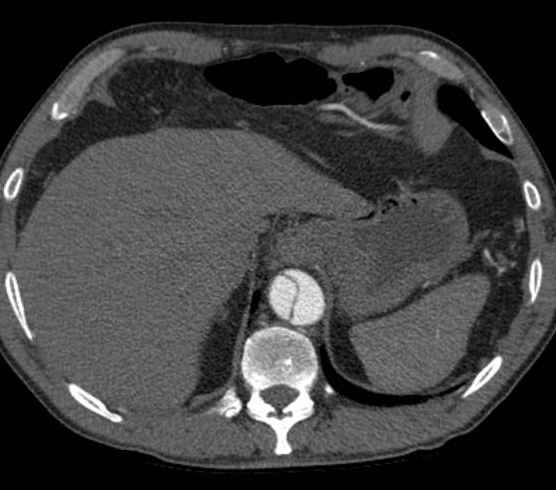 File:Aortic dissection - Stanford type B (Radiopaedia 73648-84437 A 104).jpg