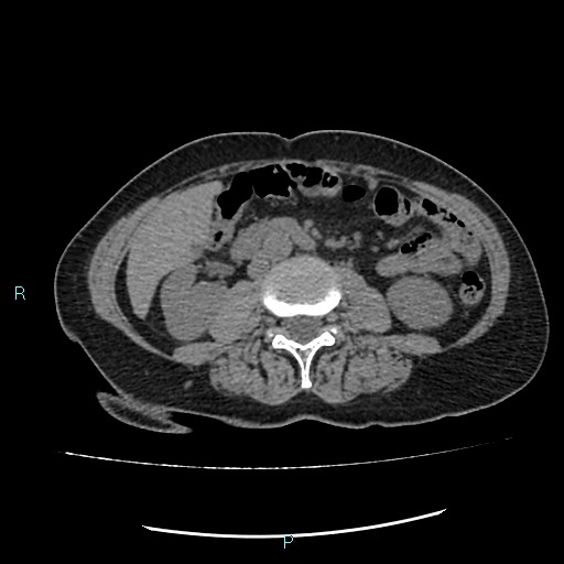 File:Aortic dissection extended to lusory artery (Radiopaedia 43686-47136 Axial non-contrast 38).jpg