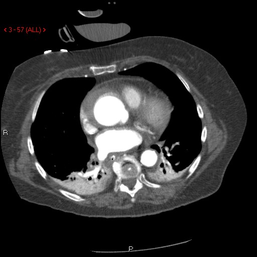 File:Aortic intramural hematoma (Radiopaedia 27746-28001 A 57).jpg