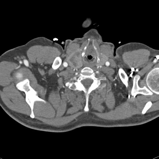Aortic intramural hematoma (Radiopaedia 31139-31838 B 2).jpg