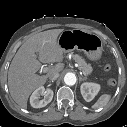 Aortic intramural hematoma (Radiopaedia 31139-31838 B 87).jpg