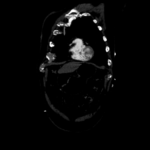 Aortic intramural hematoma (Radiopaedia 34260-35540 C 16).png