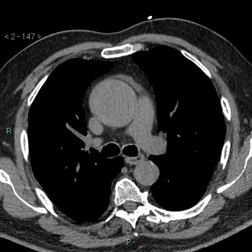 Aortic intramural hematoma (Radiopaedia 48463-53380 Axial non-contrast 65).jpg