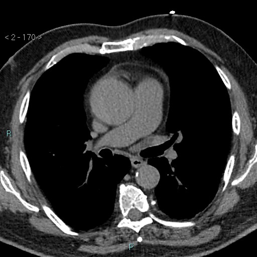 Aortic intramural hematoma (Radiopaedia 48463-53380 Axial non-contrast 76).jpg
