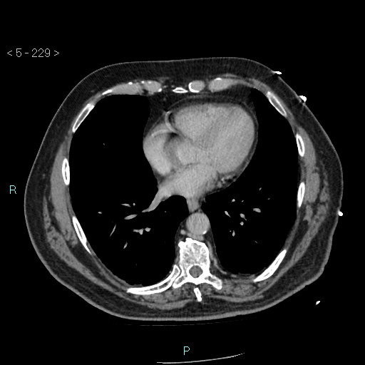 Aortic intramural hematoma (Radiopaedia 48463-53380 C 103).jpg