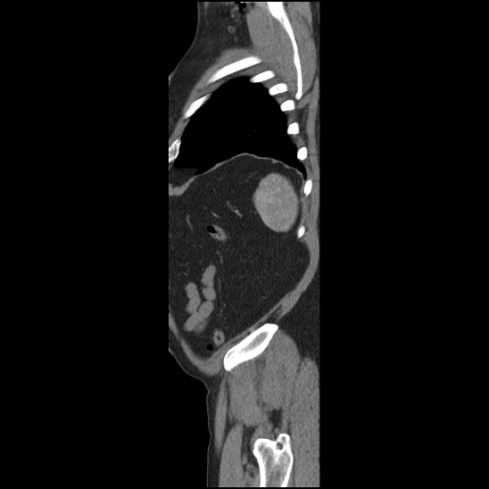 Aortic intramural hematoma (type B) (Radiopaedia 79323-92387 H 51).jpg