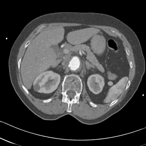 Aortic intramural hematoma from penetrating atherosclerotic ulcer (Radiopaedia 31137-31836 A 87).jpg