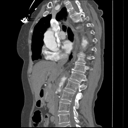File:Aortic intramural hematoma from penetrating atherosclerotic ulcer (Radiopaedia 31137-31836 B 24).jpg