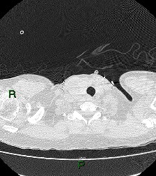 File:Aortic valve endocarditis (Radiopaedia 87209-103485 Axial lung window 7).jpg