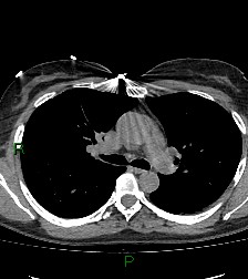 File:Aortic valve endocarditis (Radiopaedia 87209-103485 Axial non-contrast 43).jpg