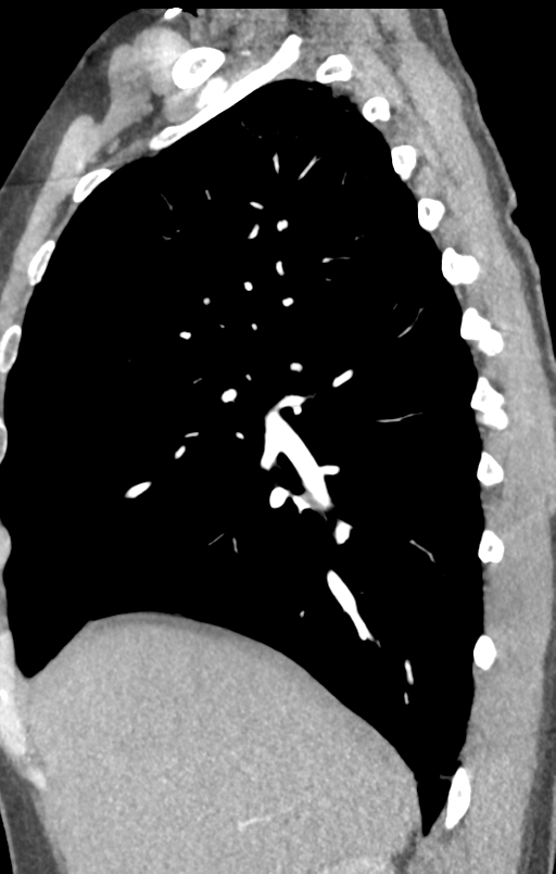 Aortic valve non-coronary cusp thrombus (Radiopaedia 55661-62189 C+ arterial phase 49).png