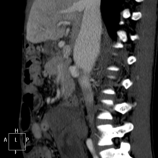 Aorto-left renal vein fistula (Radiopaedia 45534-49628 C 23).jpg