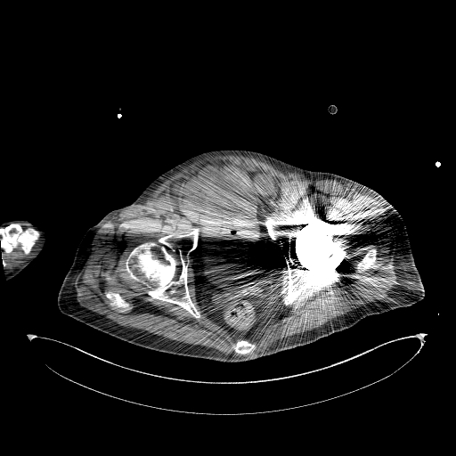 Aortoduodenal fistula (Radiopaedia 75286-86415 Axial non-contrast 72).jpg