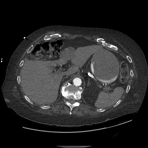 File:Aortoesophageal fistula with endovascular repair (Radiopaedia 73781-84592 Axial C+ CTPA 172).jpg