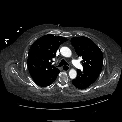Aortoesophageal fistula with endovascular repair (Radiopaedia 73781-84592 Axial C+ CTPA 50).jpg
