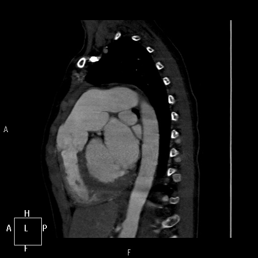 File:Aortopulmonary septal defect (Radiopaedia 41990-45013 Sagittal C+ CTPA 18).jpg
