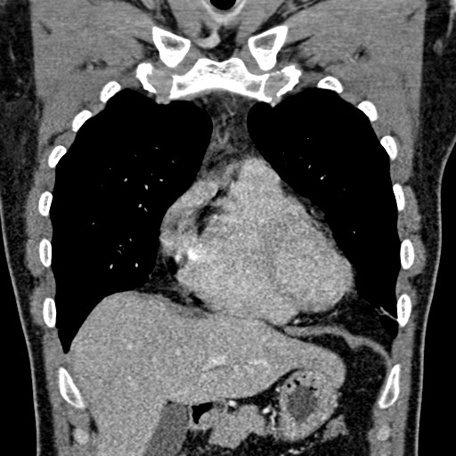 Apical lung mass mimic - neurogenic tumor (Radiopaedia 59918-67521 B 46).jpg
