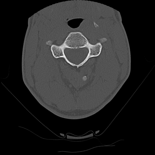 File:Apical pneumothorax on cervical spine CT (Radiopaedia 45343-49368 Axial bone window 34).jpg